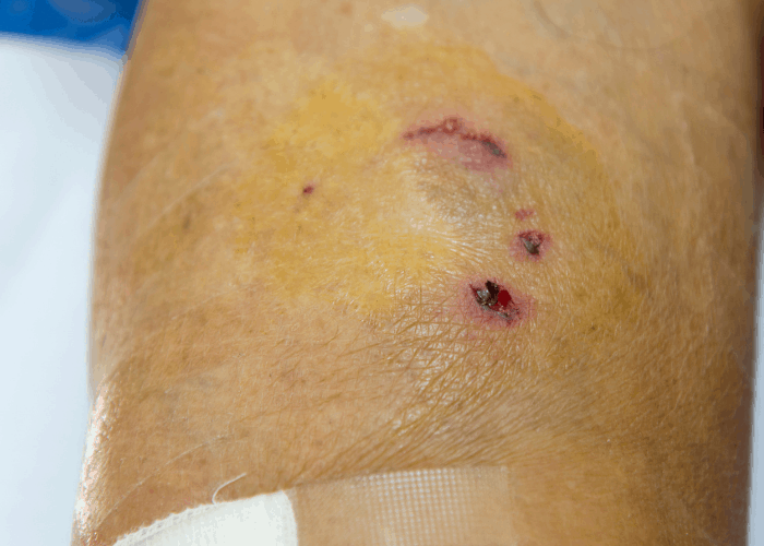 dog bite wound
