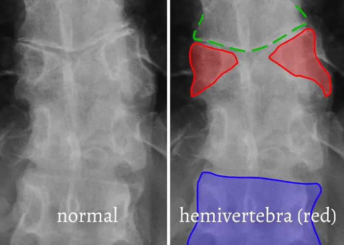 hemivertebrae in frenchie